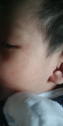 facial rashes ni Baby
