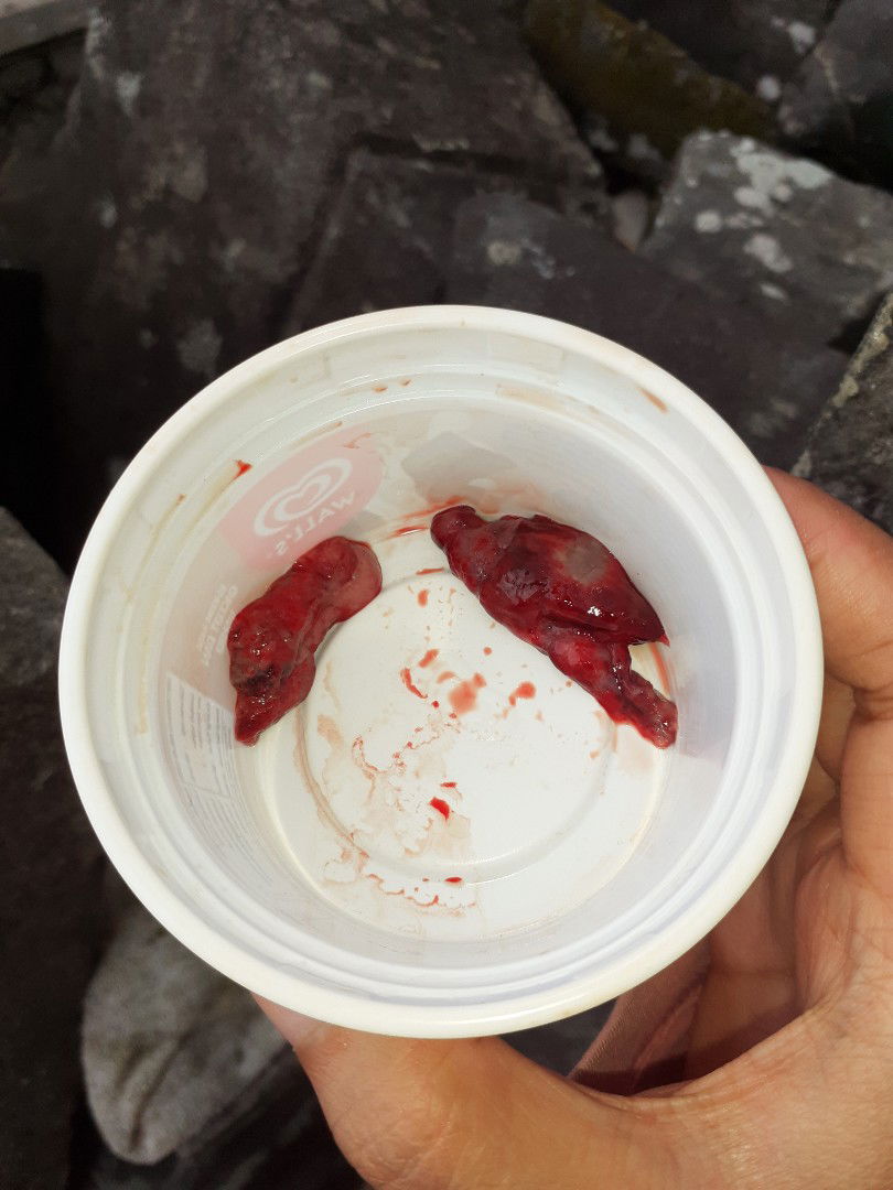 Keguguran 7 week (foto sensitif)