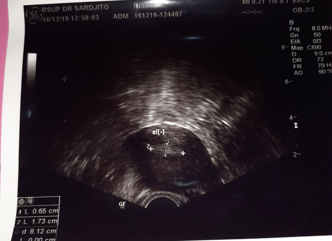 keguguran usia 7week