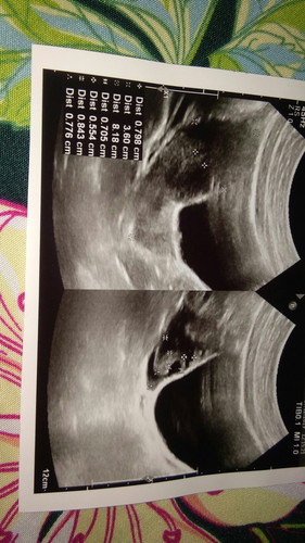 Pcos