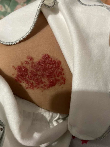 Hemangioma / kelainan pembuluh darah