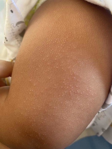 น้องเป็นผด