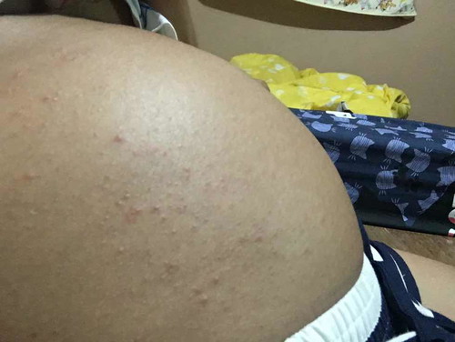 ผื่นคัน