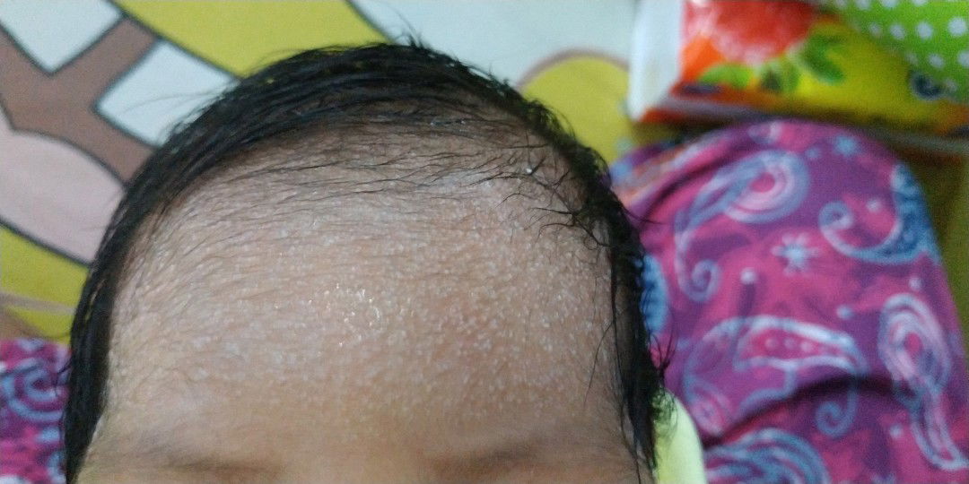 bruntusan dahi newborn