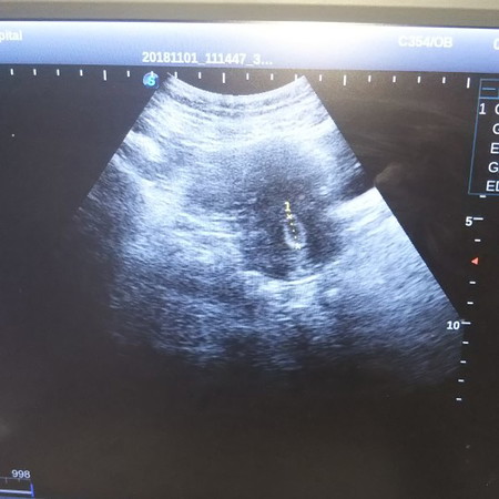 meragukan dngn hasil dokter