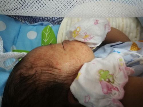 ลูกมีผื่นแดงขึ้นตามตัว มีน้ำเหลืองไหล