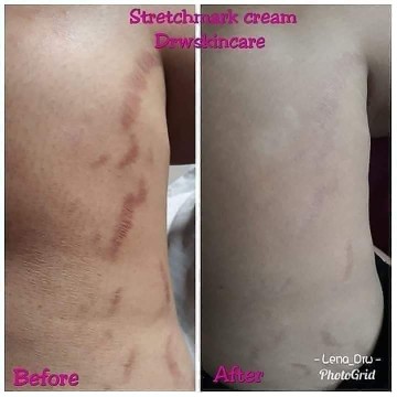 cream strechmark