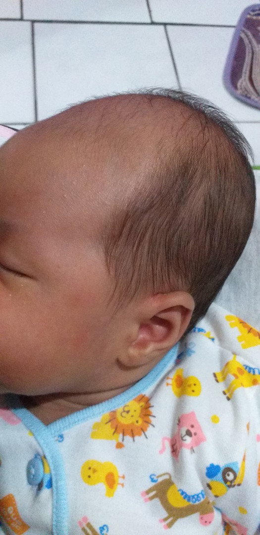 kepala bayi lonjong