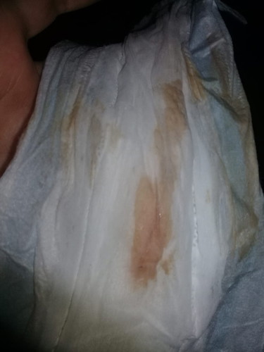 Keputihan atau flek?