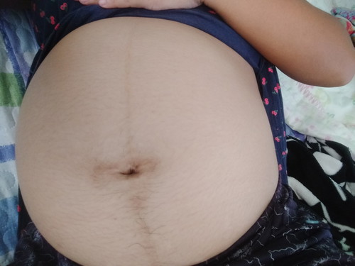 no stretchmark