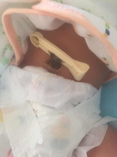 ที่ติดสะดือลูก