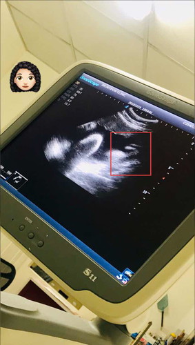 37 week เริ่มเจ็บเตือนบ่อยขึ้น