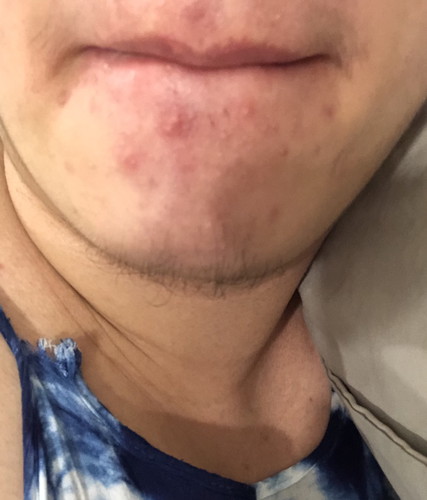 ใครมีผลของฮอร์โมนตั้งครรภ์อาการหนักแบบนี้บ้างคะ?