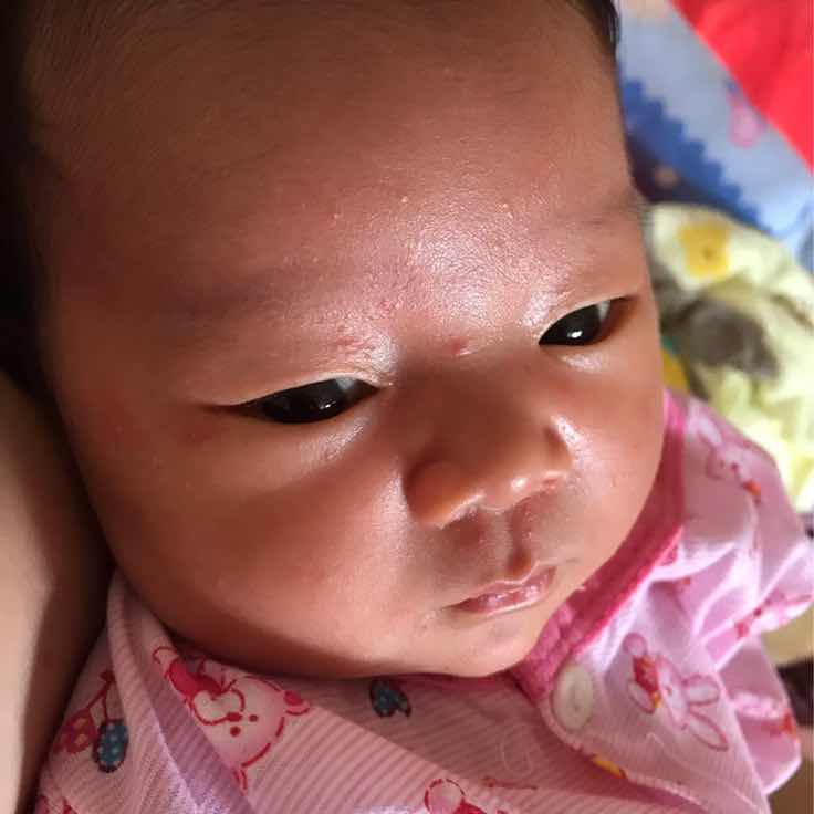 ผื่นขึ้นหน้า.