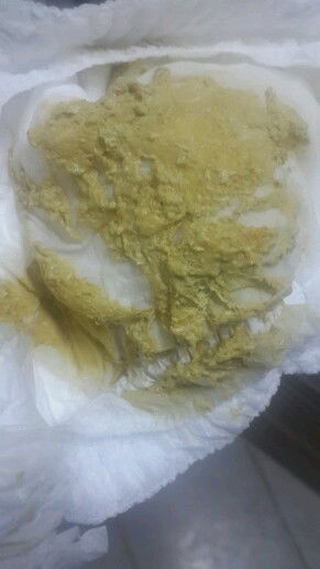 อุจาระสีเหลืองซีด