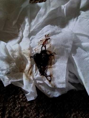 มีภาวะรกเกาะต่ำจร้า