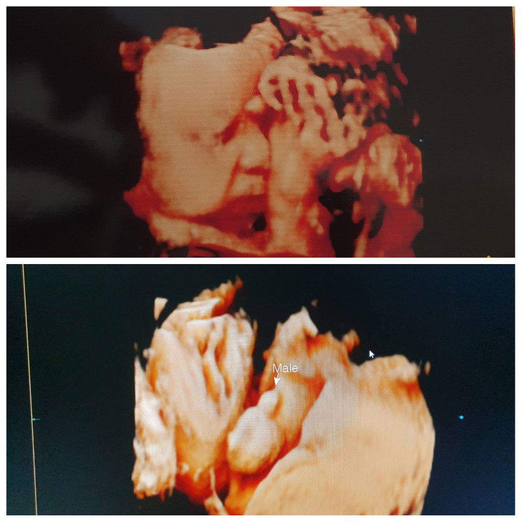 กระตุ้นปากมดลูก