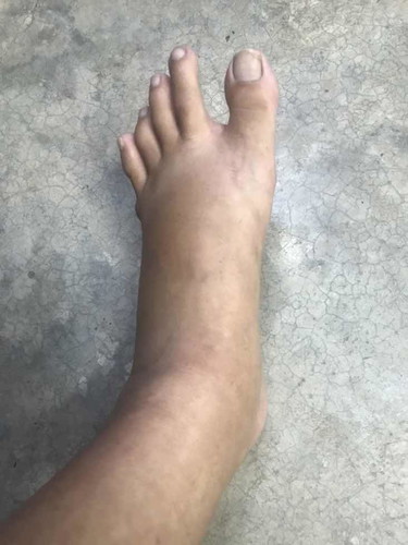 เท้าบวม