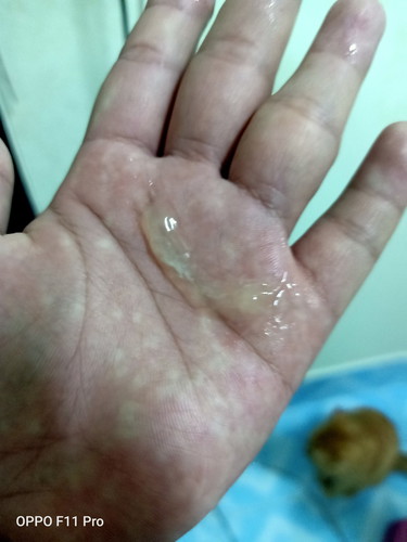 คิดว่ามีมูกออกแล้วปากมดลูกจะเปิดพร้อมคลอด แต่ยังจ้า