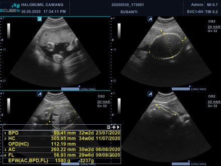 Menaikkan Berat Badan Janin