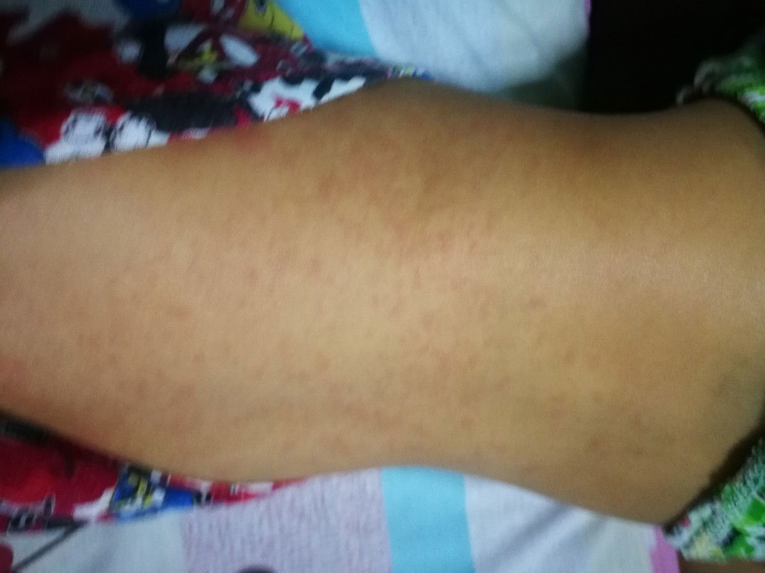 แบบนี้คือหัดมั้ยคะ