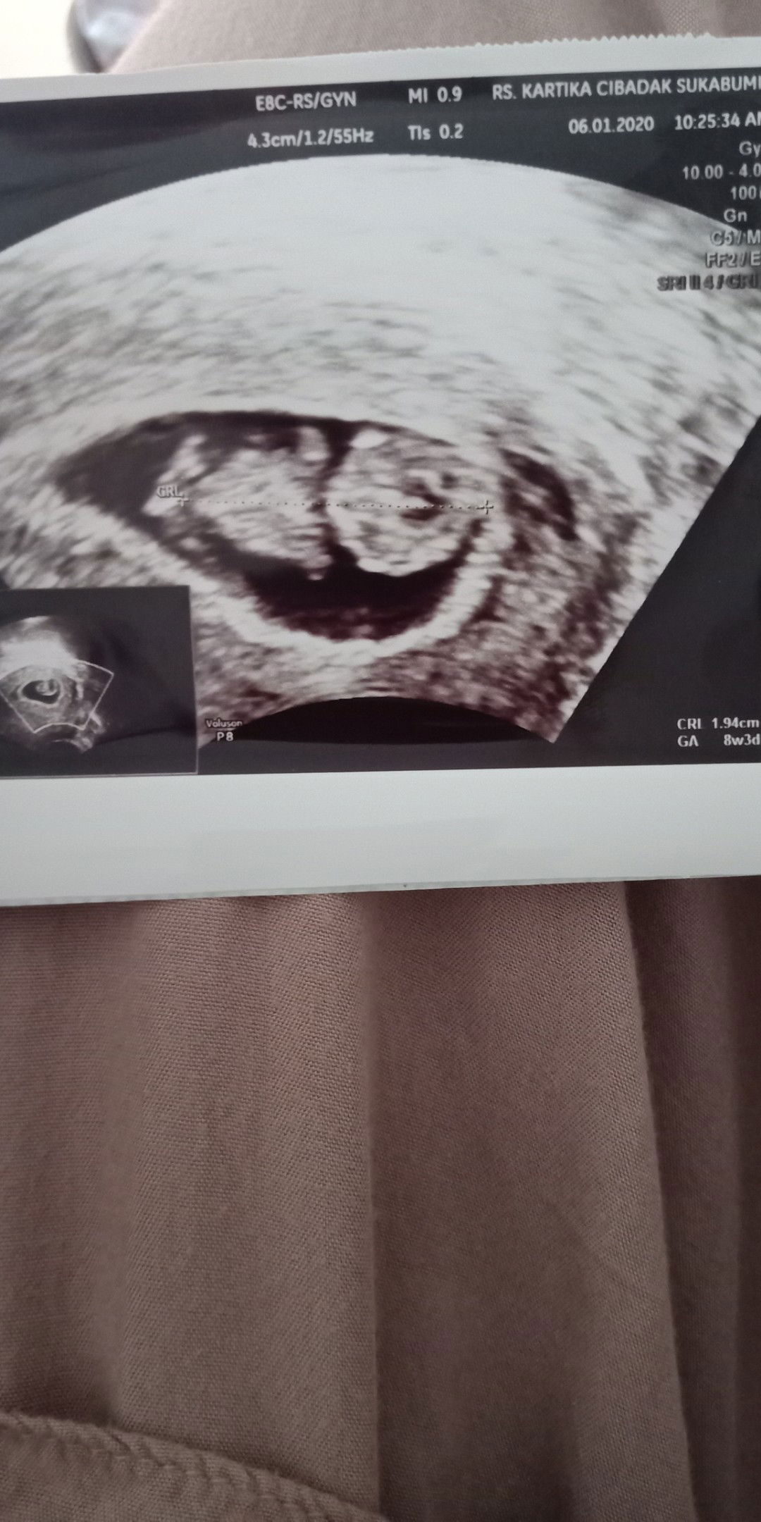 Detak jantung bayi tdk terdeteksi