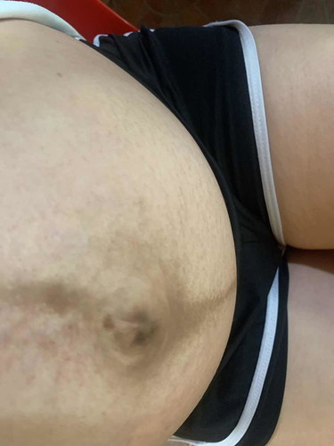 ท้องแตกลาย