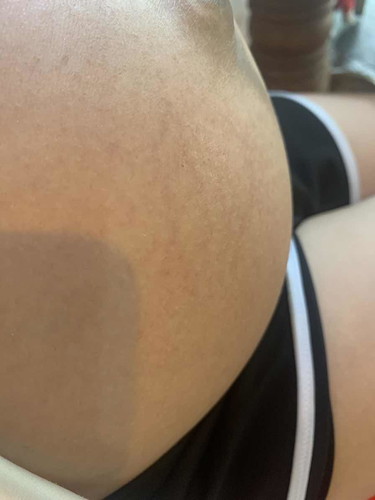 มีวิธีแก้ทัองแตกมั้ยคะ