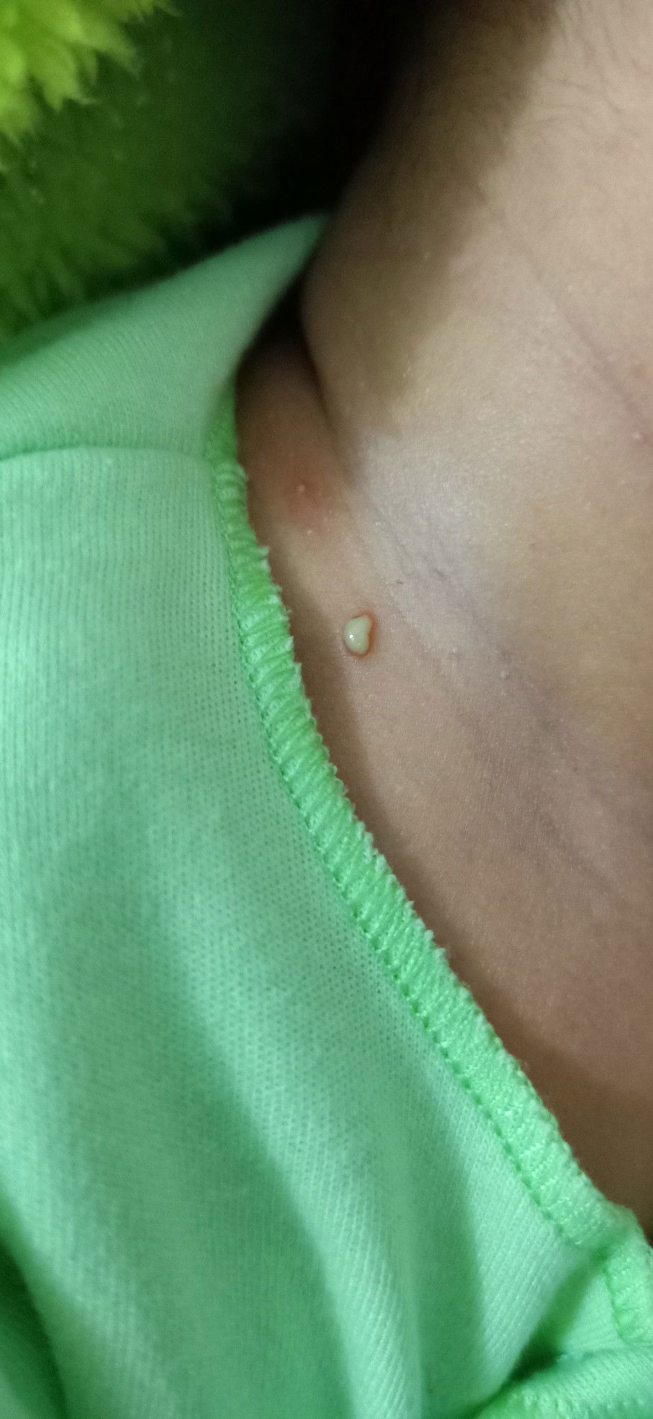 bintik seperti bisul