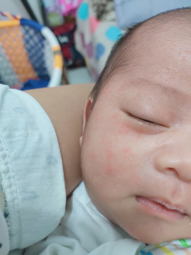 Baby Acne