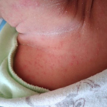 bintik merah di bayi