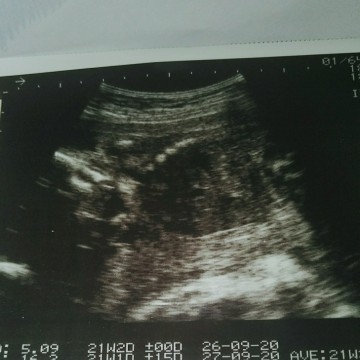 ช่วยดูให้หน่อยนะคะ...ว่าเพศไหน...ดูว่าผลอัลตร้าซาวด์ชัวไหม