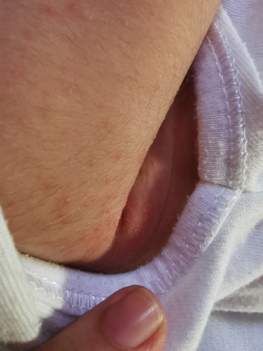 Rashes?