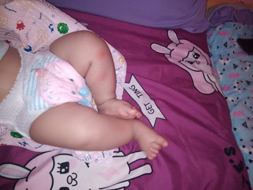 ตุ่มที่คล้ายยุงกัด