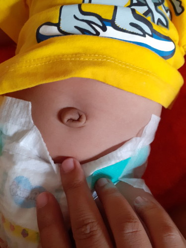 สะดือลูก2เดือน