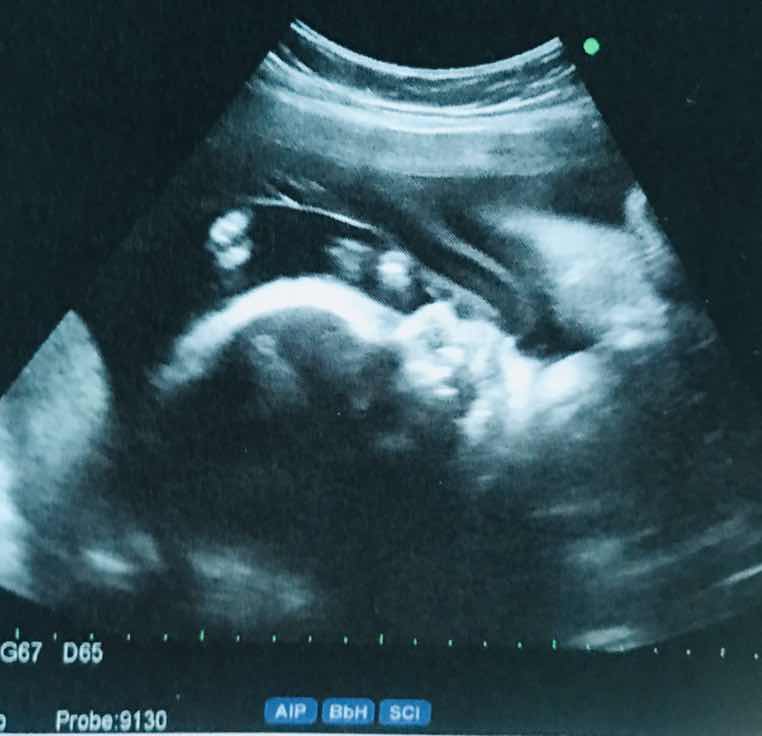 หมอบอกว่าลูกตัวโตเกินไป แม่แอบกลุ้มใจค่ะ