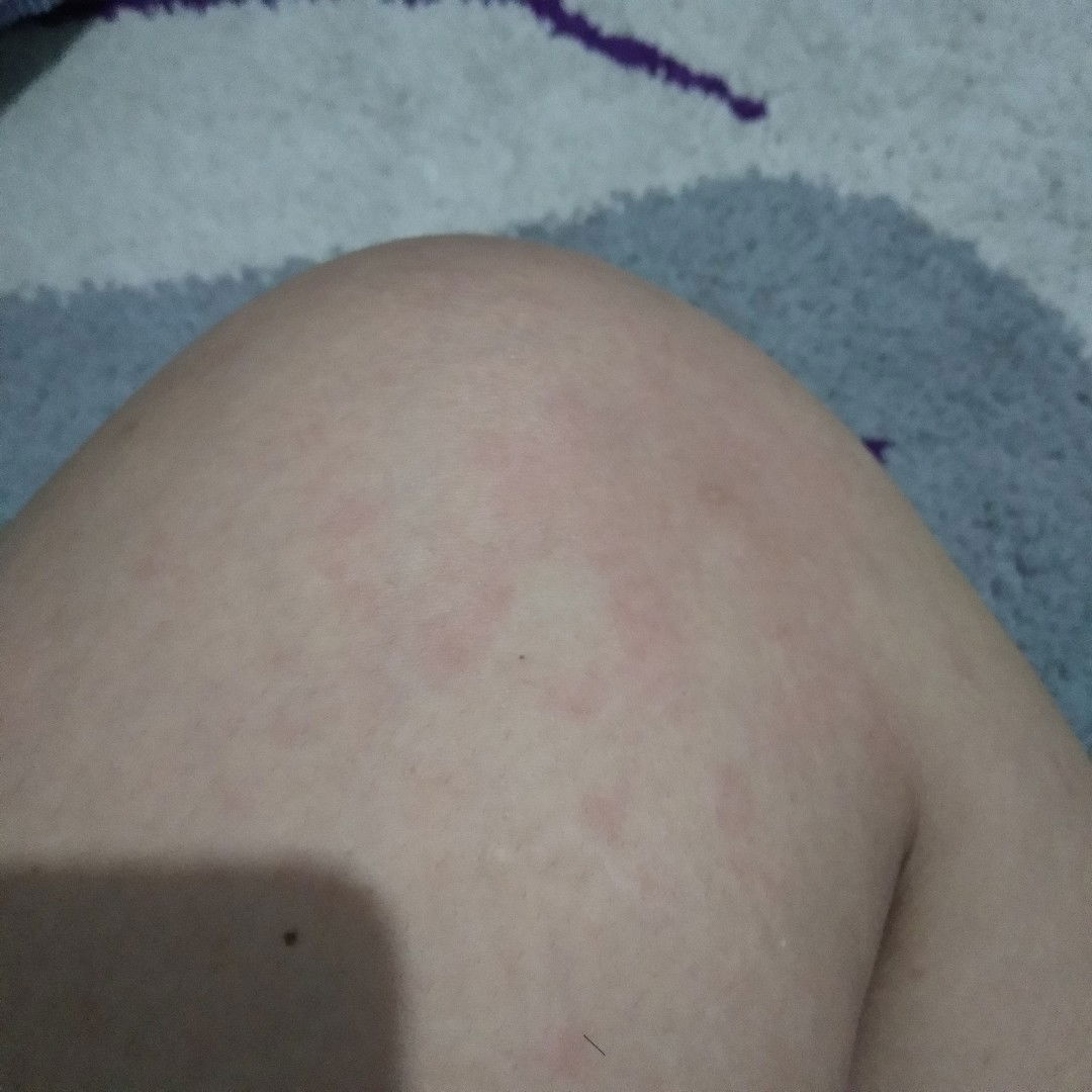 biduran pasca melahirkan