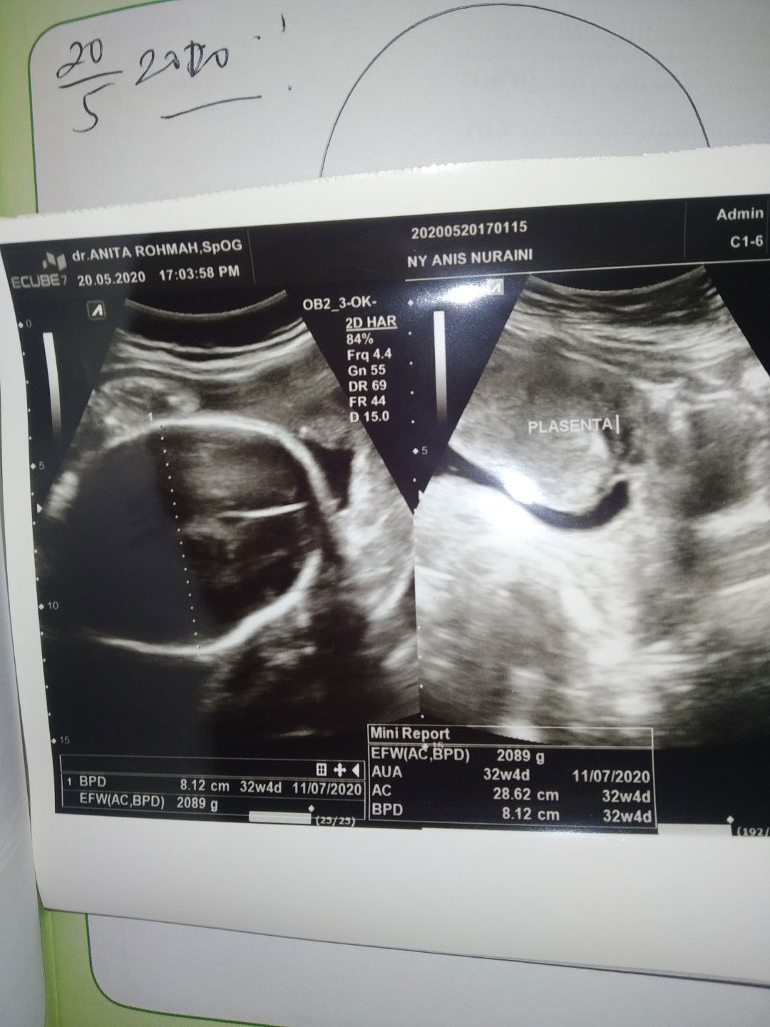 plasenta nutup jalan lahir