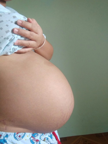 ลูกกลับหัว ท้องลด