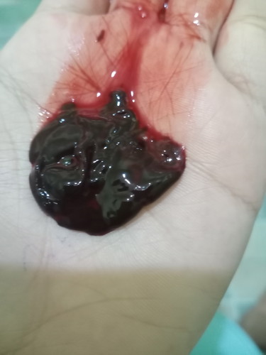เลือดออกทองช่องคลอด