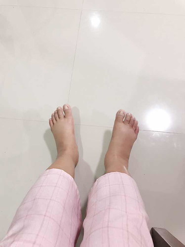 34 W บวมมาก