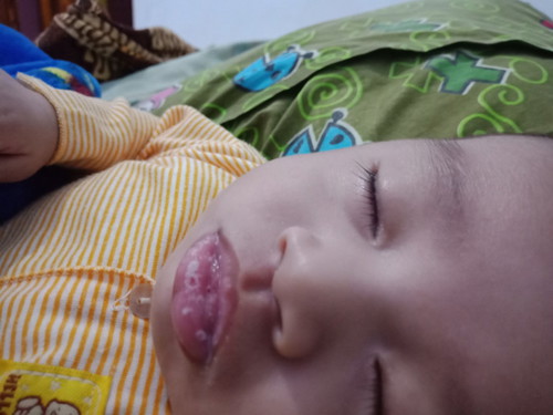 bercak putih d lidah dan bibir