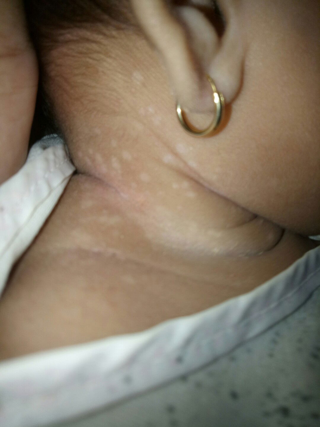 ngilangin bekas merah merah