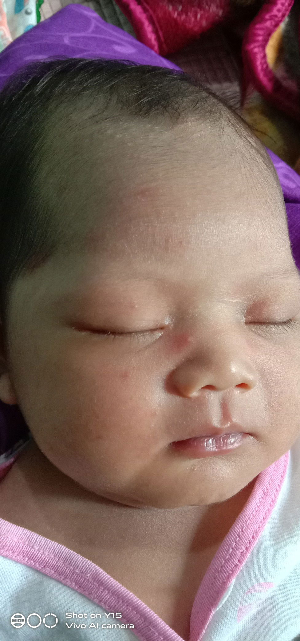 biang keringat di kepala dan jidat