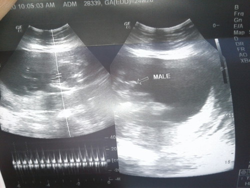 24 weeks and 2 days ultrasound