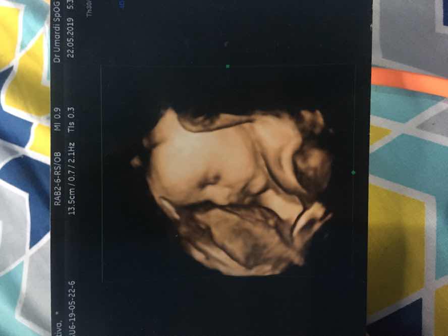 DJJ bayi negatif kehamilan 37 weeks