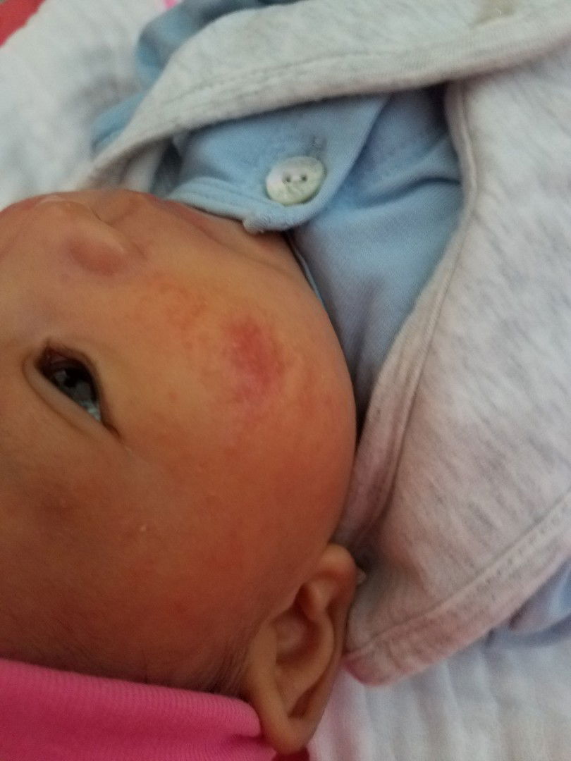 Bé bị như này có phải chàm sữa không?