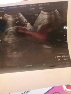 ternya bayiku kembar bun pantesan perut nua besas baru ketauan 9 bulan