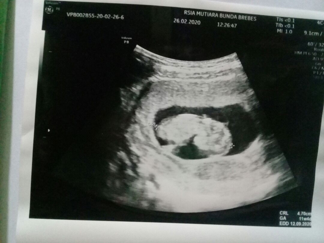 keluar cairan tpi tdk berbau sama kluar darah