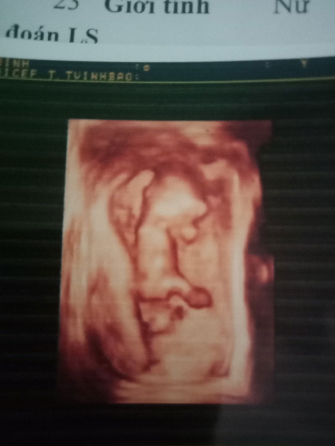 cac m oi.11tuan 5ngay ma s.am độ dày da gay la 1 mm thi bt chu a.